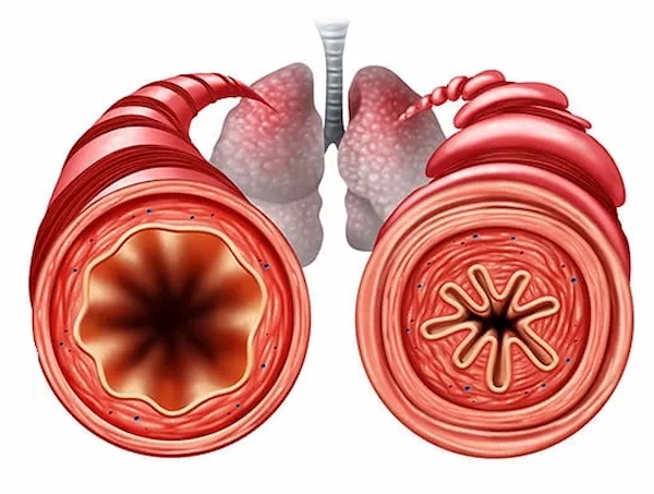 اسپاسم برونشیال: دلایل، علائم، تشخیص و درمان