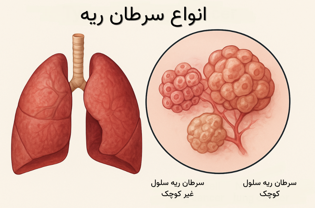 انواع سرطان ریه و ویژگی‌های مراحل مختلف آن