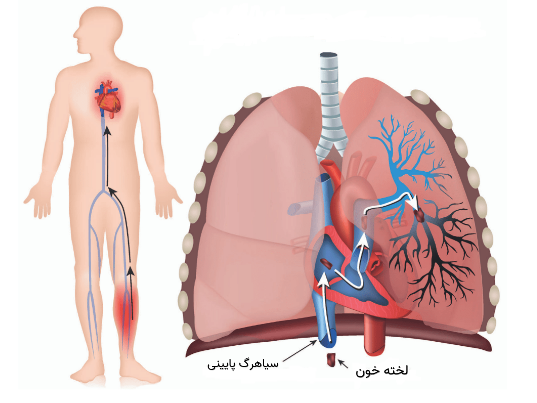راهنمای کامل تشخیص و درمان بیماری آمبولی ریه